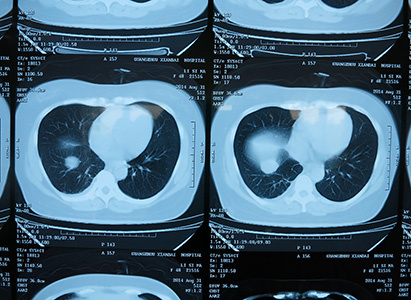 endometrical-cancer-02