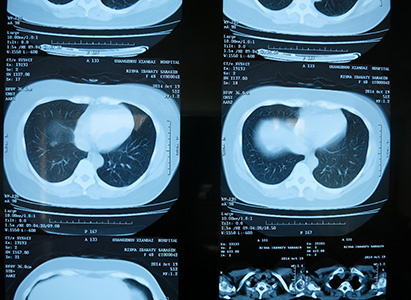 endometrical-cancer-03